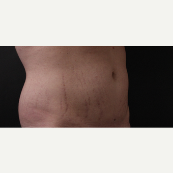 30 year old man treated with CoolSculpting after 3630360