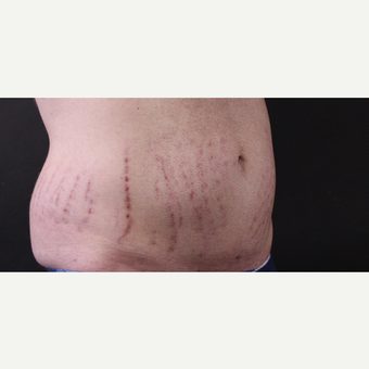 30 year old man treated with CoolSculpting before 3630360