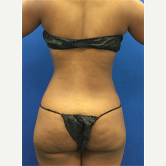 25-34 year old woman treated with Liposuction after 3142171