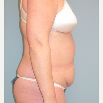 40 year old woman treated with Tummy Tuck before 3343732