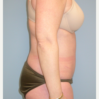 40 year old woman treated with Tummy Tuck after 3343732