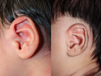 1 month old child treated with EarWell Appliance. before 3499460