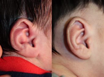 1 month old child treated with EarWell Appliance. after 3499460