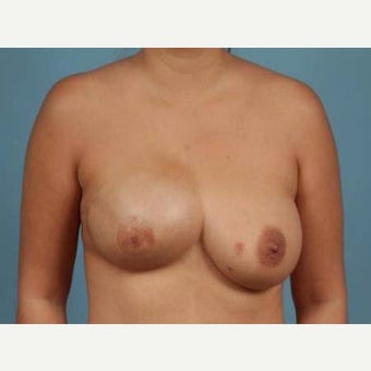 Breast Reconstruction Revision before 2389481