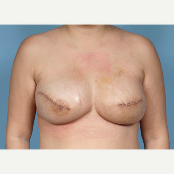 Breast Reconstruction Revision after 2389481