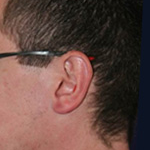 Ear Lobe Surgery after 3710615
