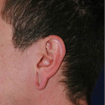 Ear Lobe Surgery before 3710615