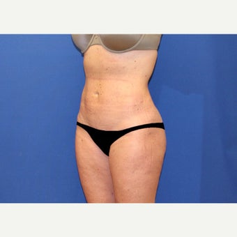 45 year old woman treated with Mini Tummy Tuck and Contour Liposuction after 2515628