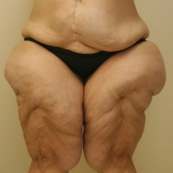 35-44 year old woman treated with Thigh Lift before 1748368