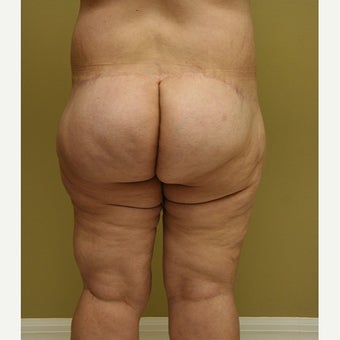 35-44 year old woman treated with Thigh Lift 1748368