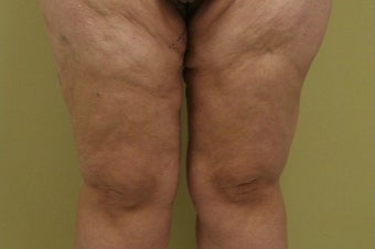 35-44 year old woman treated with Thigh Lift after 1748368