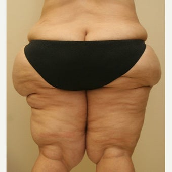 35-44 year old woman treated with Thigh Lift 1748368