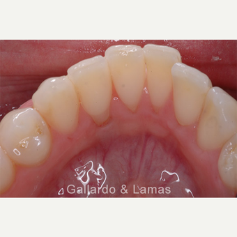 25-34 year old woman treated with Gum Lift before 3075237