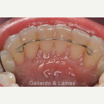 25-34 year old woman treated with Gum Lift after 3075237