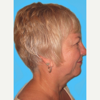 Facelift before 3824958