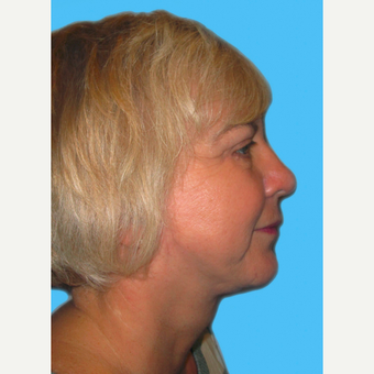 Facelift after 3824958