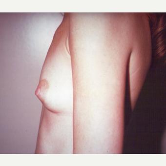 25-34 year old woman treated with Breast Augmentation before 3538682