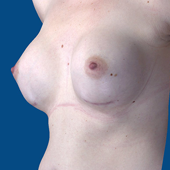 25-34 year old woman treated with Breast Augmentation after 3848604