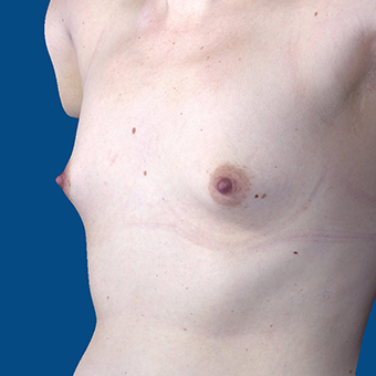 25-34 year old woman treated with Breast Augmentation before 3848604