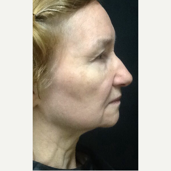 75 and up year old woman treated with Ultherapy after 3383033