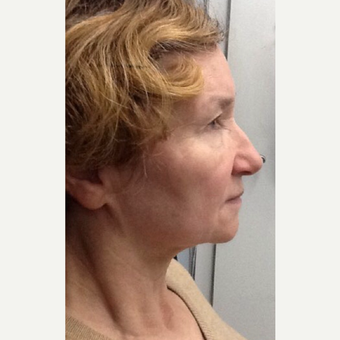 75 and up year old woman treated with Ultherapy before 3383033