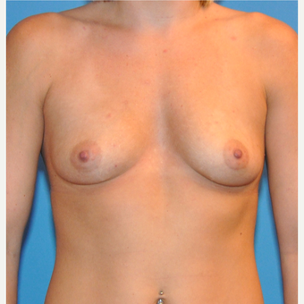Breast Augmentation before 3377423