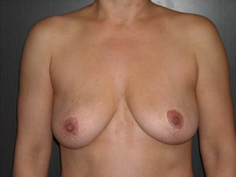 35-44 year old woman treated with Breast Implant Removal after 1698723