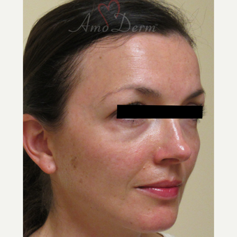 35-44 year old woman treated with Voluma in cheeks before 3222812