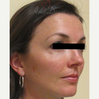 35-44 year old woman treated with Voluma in cheeks after 3222812