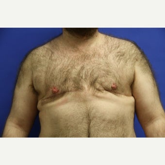 38 year old trans man treated with FTM Chest Masculinization Surgery after 2097038