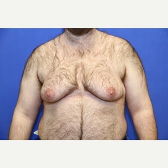 38 year old trans man treated with FTM Chest Masculinization Surgery before 2097038