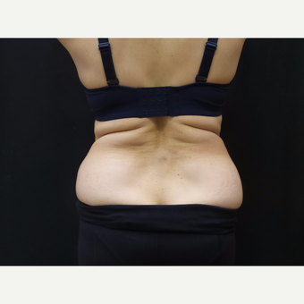 65 year old woman treated with SculpSure before 2767548