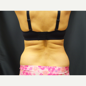 65 year old woman treated with SculpSure after 2767548