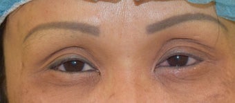 45-54 year old woman treated with Asian Rhinoplasty before 3305775