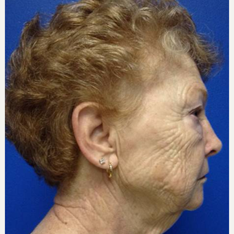 65-74 year old woman treated with Pearl Laser before 3506441