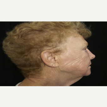 65-74 year old woman treated with Pearl Laser after 3506441