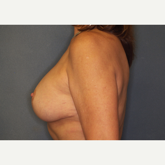 55-64 year old woman treated with Breast Implant Revision after 3061220