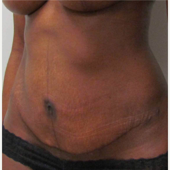 Tummy Tuck for this 35 Year Old Woman after 3092511