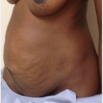 Tummy Tuck for this 35 Year Old Woman before 3092511