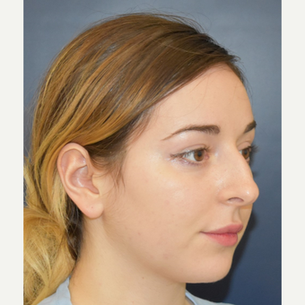 18-24 year old woman treated with Septoplasty before 3503486