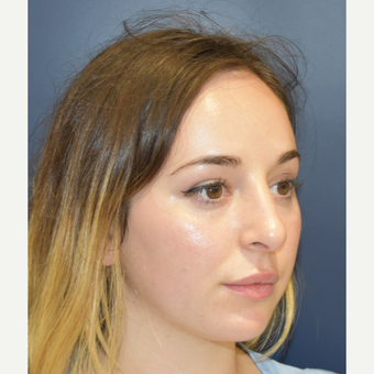 18-24 year old woman treated with Septoplasty after 3503486