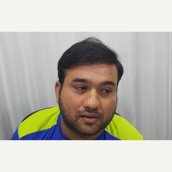 35-44 year old man treated with FUE Hair Transplant after 3337349