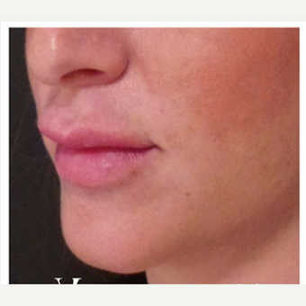 Fixing 'trout pout' with Hyaluronidase injection before 3358746