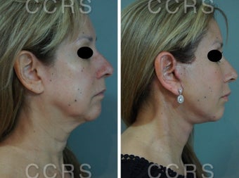55 year old woman treated with SMAS Facelift before 3031538