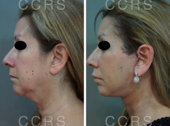 55 year old woman treated with SMAS Facelift after 3031538