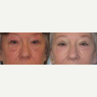 Lower eyelid lift with laser skin resurfacing and fat grafting for festoons before 3730127