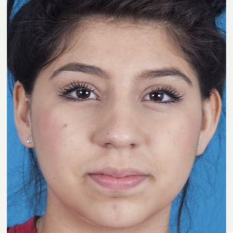 17 or under year old woman treated with Rhinoplasty after 3115257