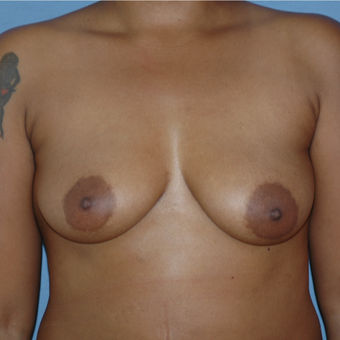 25-34 year old woman treated with Breast Augmentation before 3147247