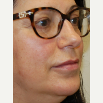 55-64 year old woman treated with Silikon 1000 for Lip Augmentation - Two treatments after 3542356