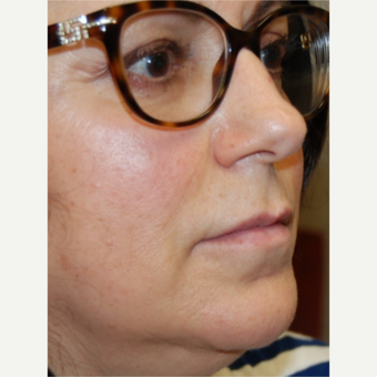 55-64 year old woman treated with Silikon 1000 for Lip Augmentation - Two treatments before 3542356